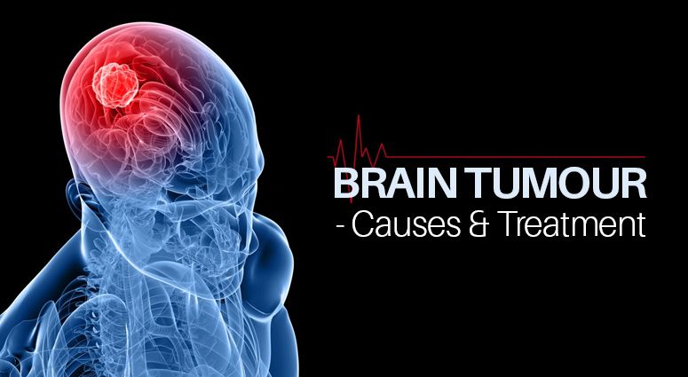 Brain Tumors Causes Symptoms Diagnosis And Treatment Guide